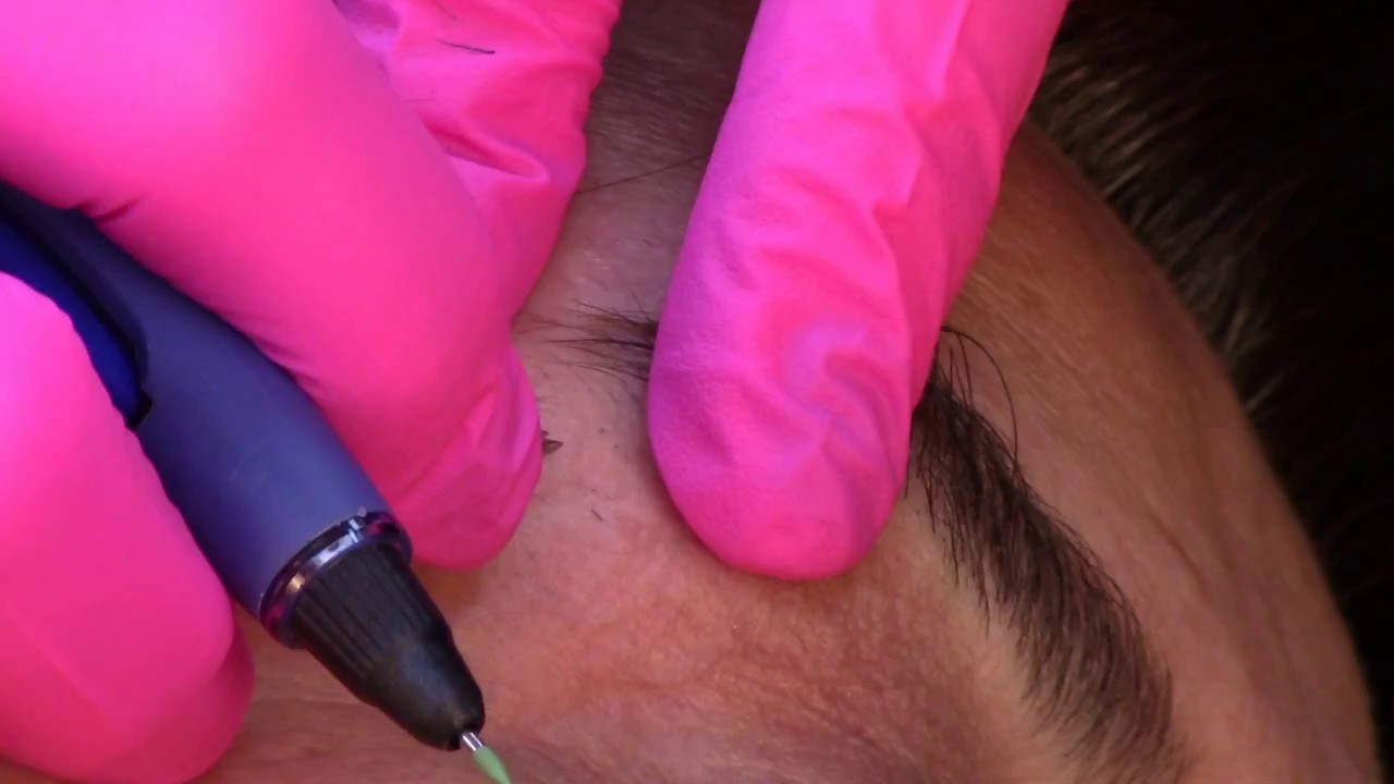 Insertion of the electrolysis probe into the hair follicle for effective permanent hair removal