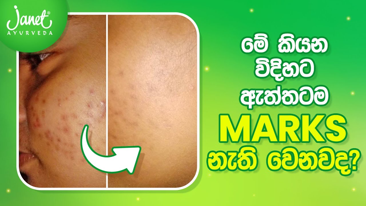 Marks වලට විසඳුමක් තාම හොයා ගත්තෙ නැද්ද? | දවස් 14න් Marks නැති කරගමුද?