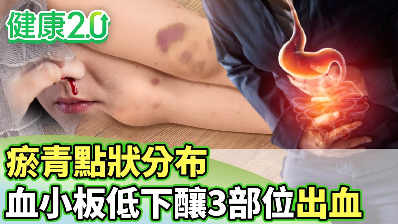 瘀青點狀分布 血小板低下釀鼻、牙齦、腸胃道出血【健康2.0 分段】