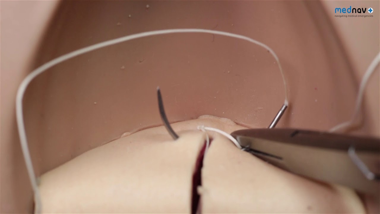 How to repair an episiotomy or 1st & 2nd degree Perineal tear