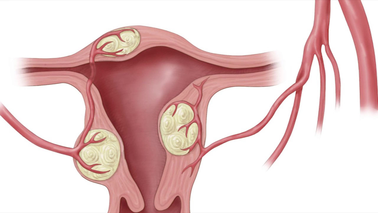 Embolizzazione fibroma uterino