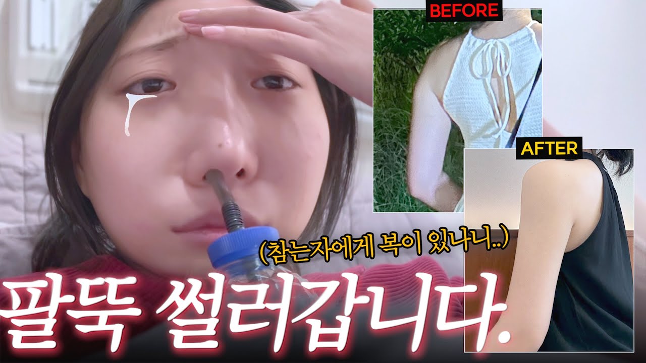 팔지흡 븨로그✌️| 수술당일~2주차 멍,붓기+꿀팁까지 갈아넣은 뼈팔되는 과정🔥