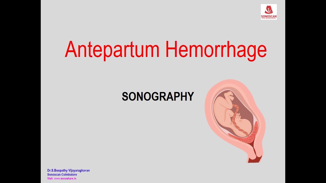 Antepartum Hemorrhage - Sonography