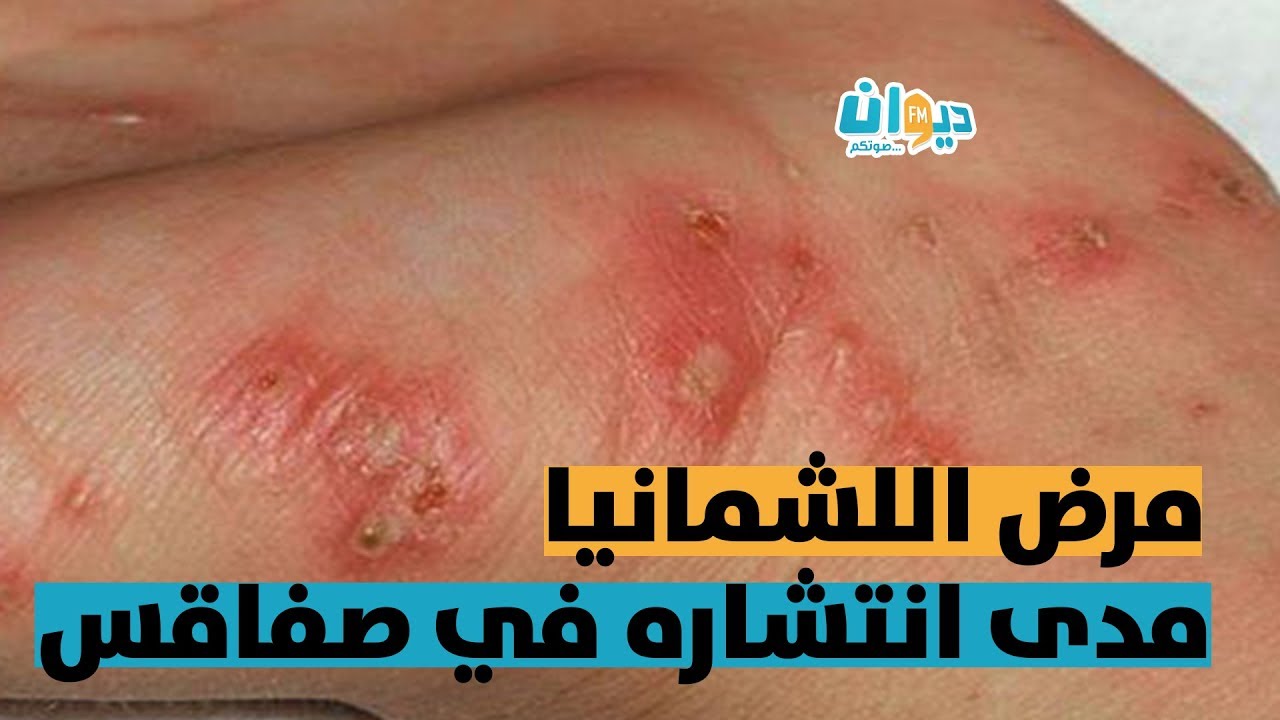 مرض اللشمانيا: مدى انتشاره في صفاقس