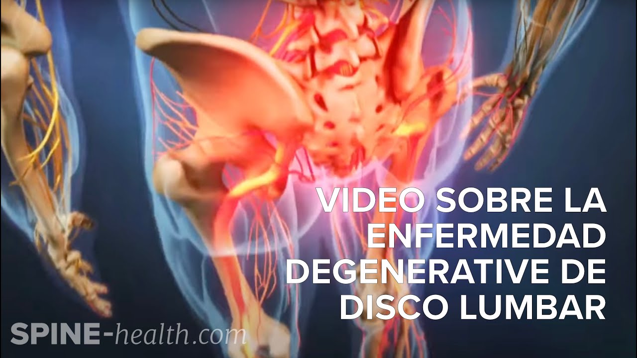 Video sobre la enfermedad degenerativa de disco lumbar