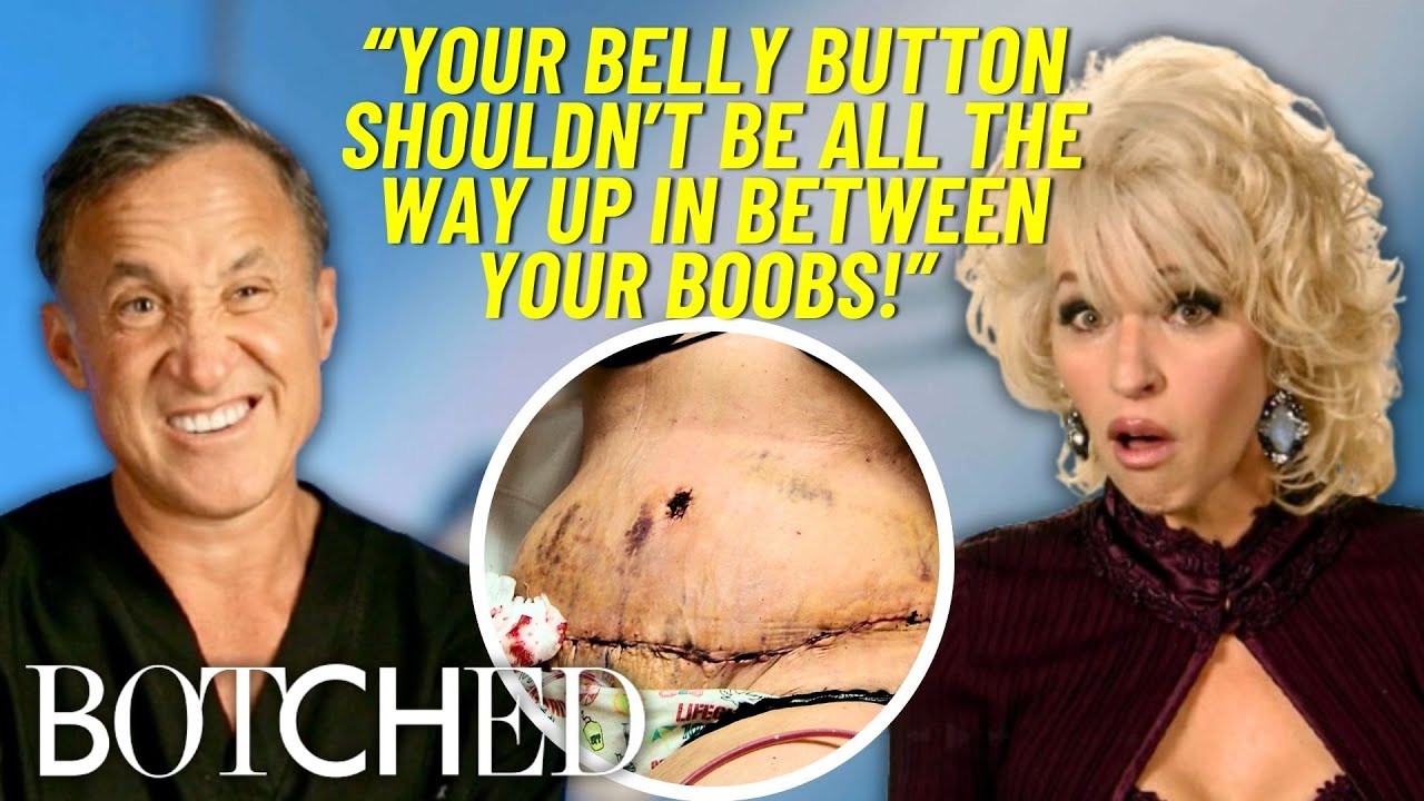 Dolly Parton Impersonator Seeks Help After Failed Tummy Tuck & Gastric Bypass Surgery | Botched | E!