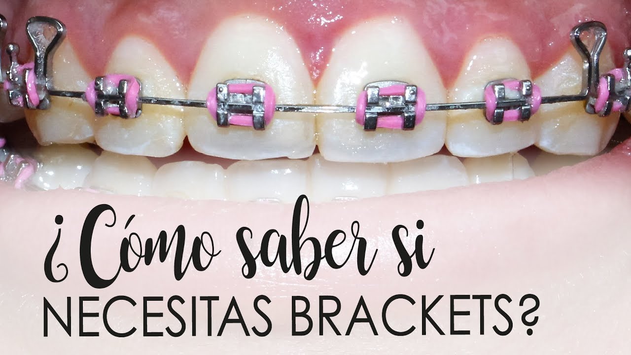 ¿CÓMO SABES SI NECESITAS BRACKETS? | CASOS QUE NECESITAN ORTODONCIA