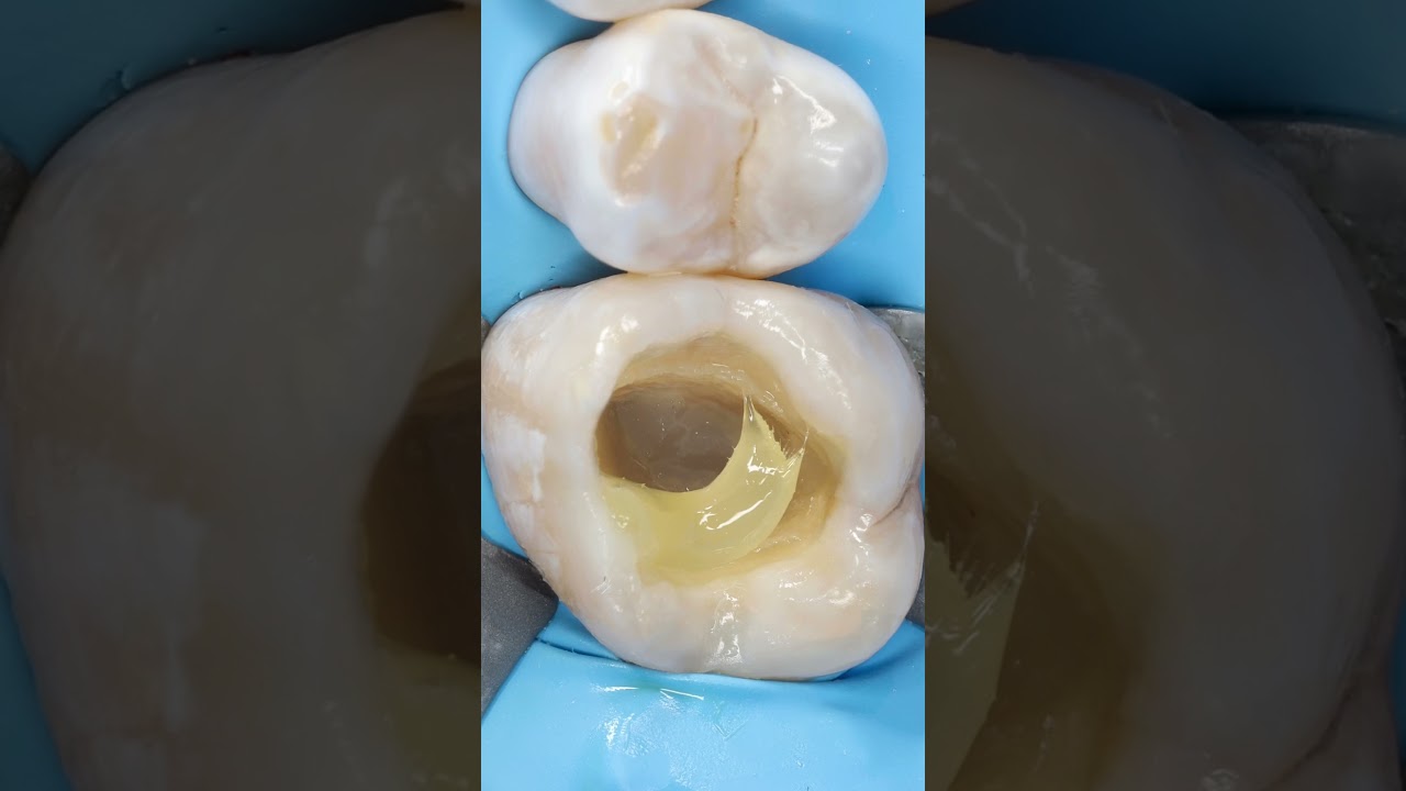 Resina directa reforzada con fibras. Odontología Biomimética  #dentista #odontologia