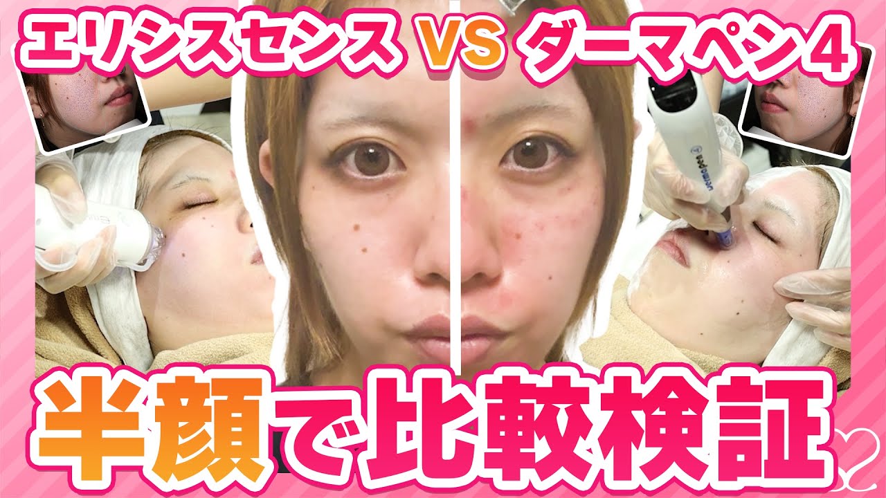 【 半顔検証 】エリシスセンス vs ダーマペン４ ！ダウンタイムや効果の違いを比較！
