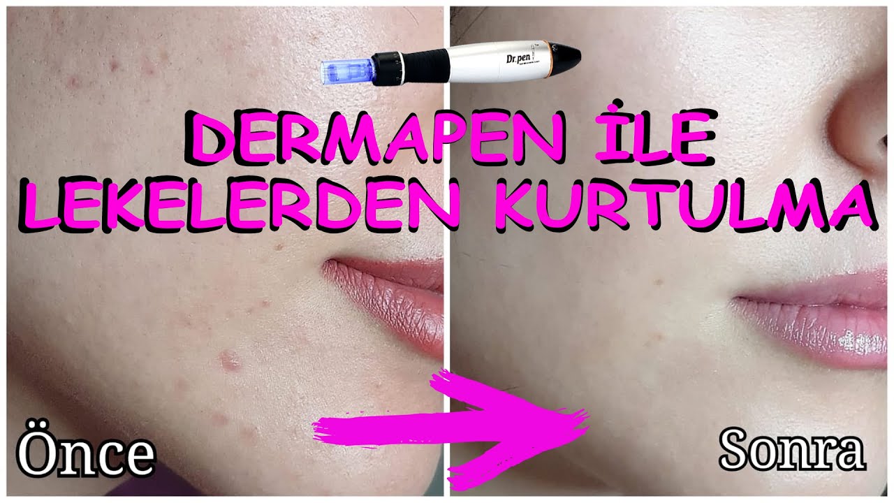 EVDE DERMAPEN UYGULAMASI │Sonunda Sivilce İzlerimden Kurtuldum 😍