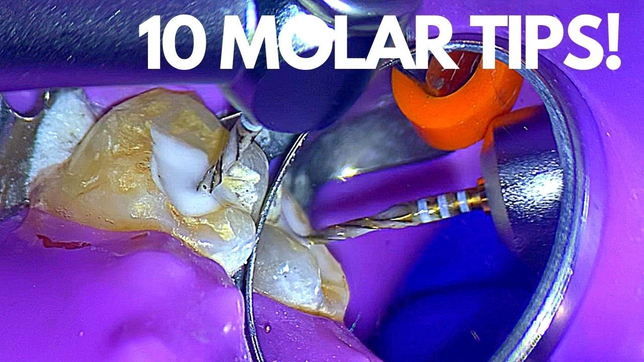 Top 10:  Molar Root Canal Tips To Make Life Easier