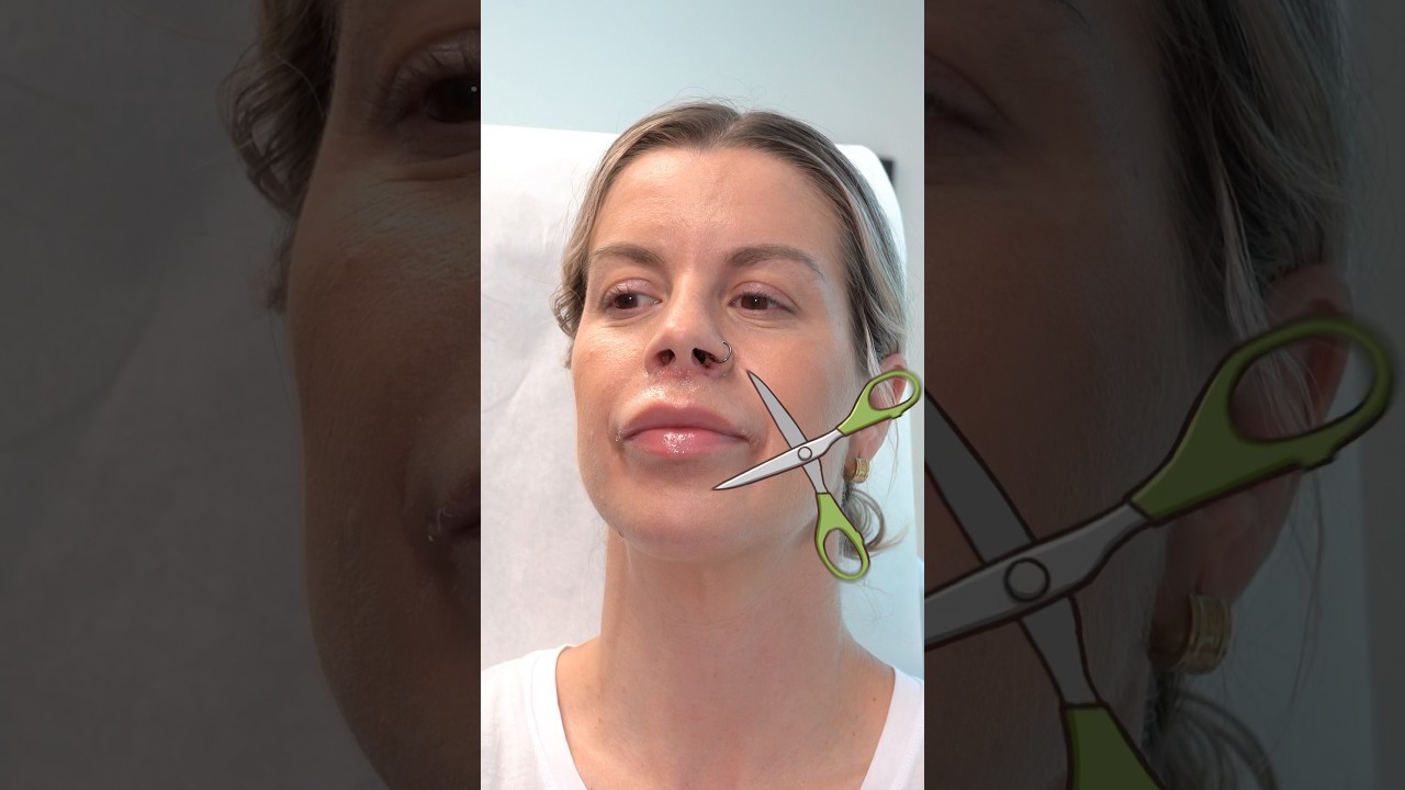 Bullhorn Lip Lift 1 Week Post-Op | 8 West Clinic #liplift #lipflip #facialscars