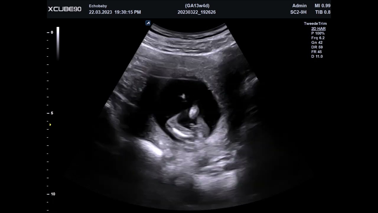 Echo 13 Weken Geslachtsbepaling, Foto's Jongens