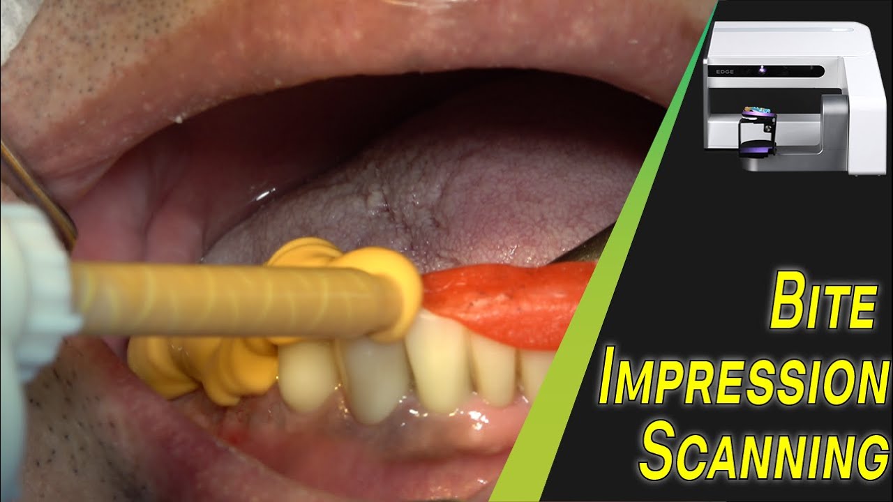Bite tray impression and impression scanning