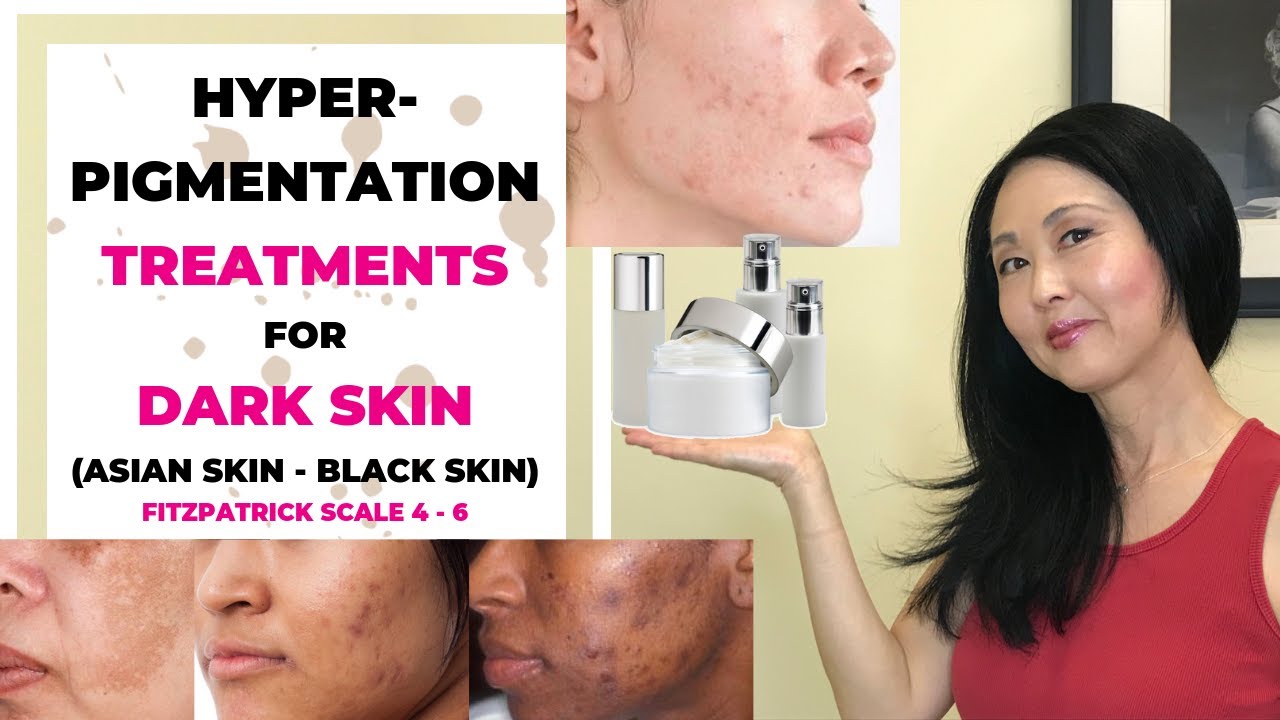 Hyperpigmentation Treatments for Dark Skin