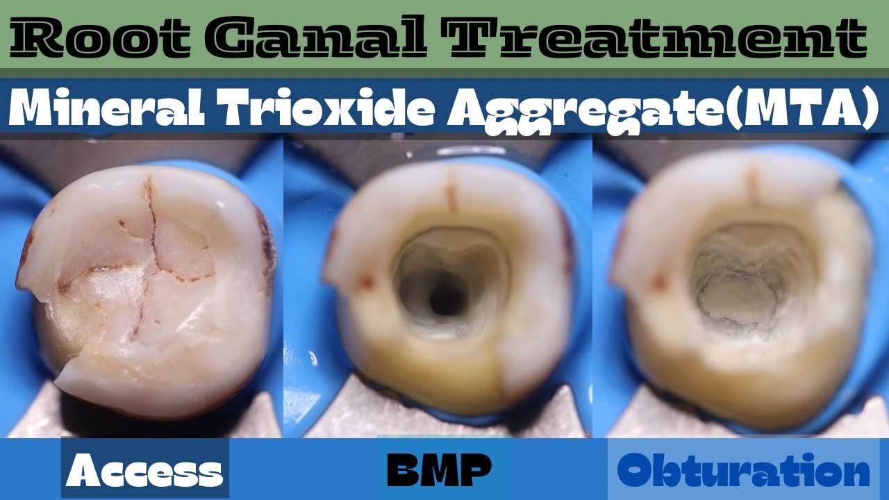Root Canal Treatment with MTA 🟢 mandibular molar with single root ⚪️ Precident burs 🟣 Rainbow Files