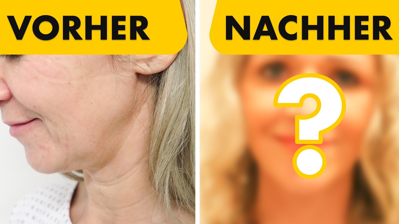 Facelift & Halslift schon mit 47 Jahren: Vorher & Nachher!