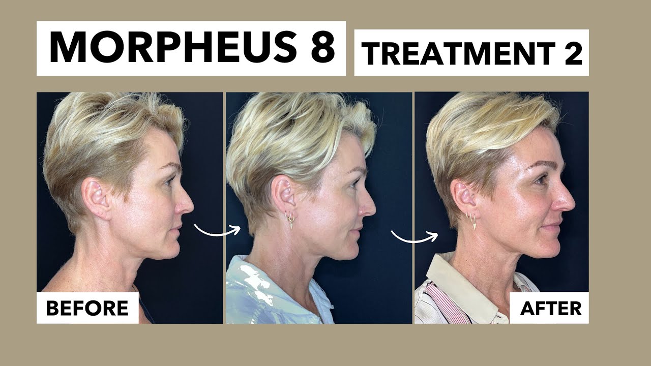 Morpheus 8 Second Treatment  // Non Surgical Facelift // Before and After Treatment 2