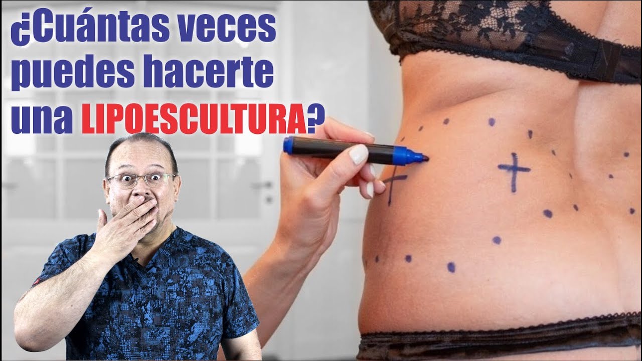 LIPOESCULTURA SECUNDARIA 👙 Te puedes hacer una LIPOSUCCIÓN por SEGUNDA vez 🍑 Dr ALBERTO CALVO QUIROZ