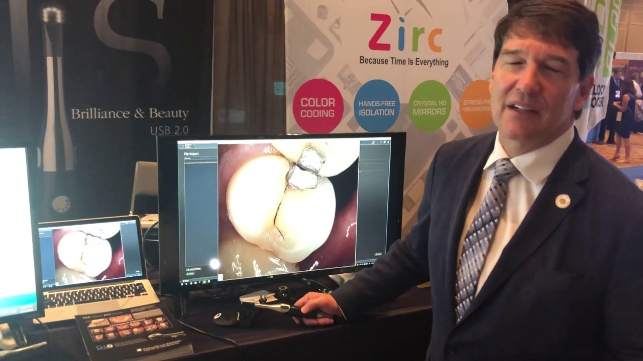 Intraoral Camera Results with HD and LūM Caries Detection by Dr. Mark Hyman