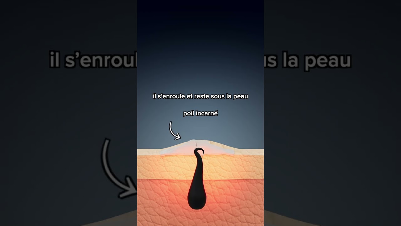 Condamnation &agrave; perp&eacute;tuit&eacute; 👩&zwj;⚖️ - Les poils incarn&eacute;s c'est STOP ! 🛑✋ #rasoirdesurete #poilsincarn&eacute;