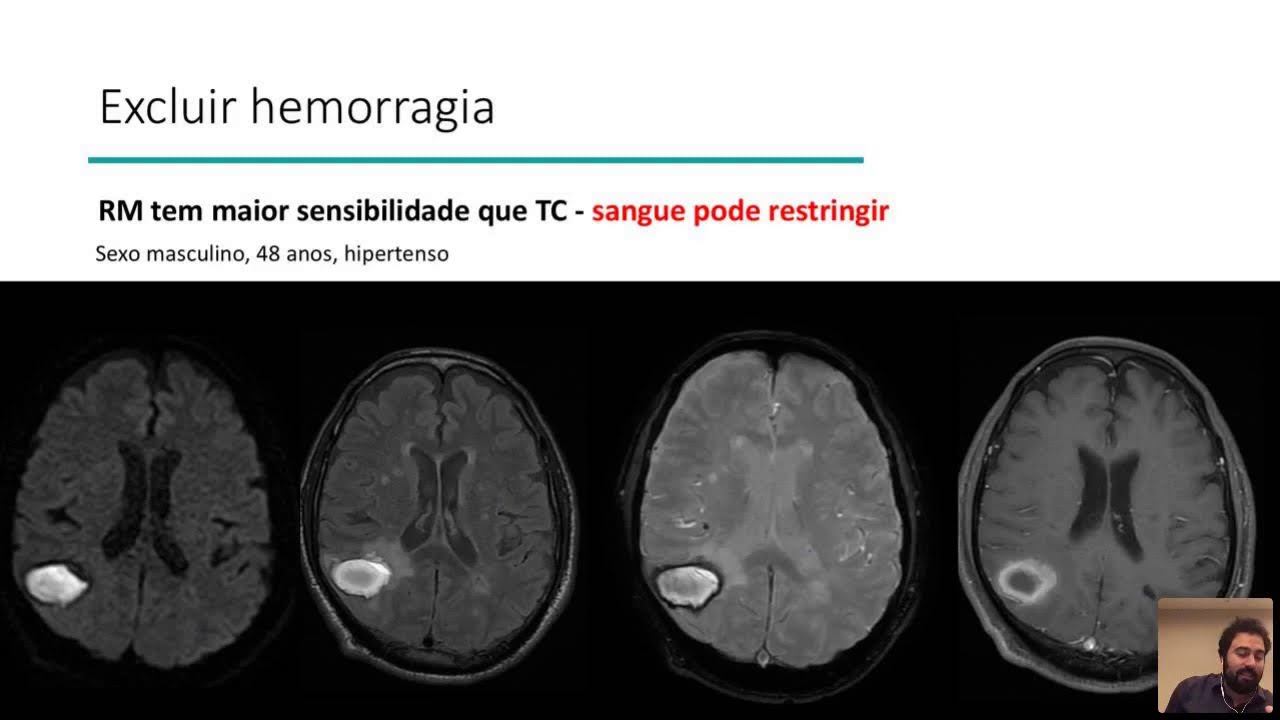 GSA - Neuroimagem no AVC agudo: RM e TC Perfusão