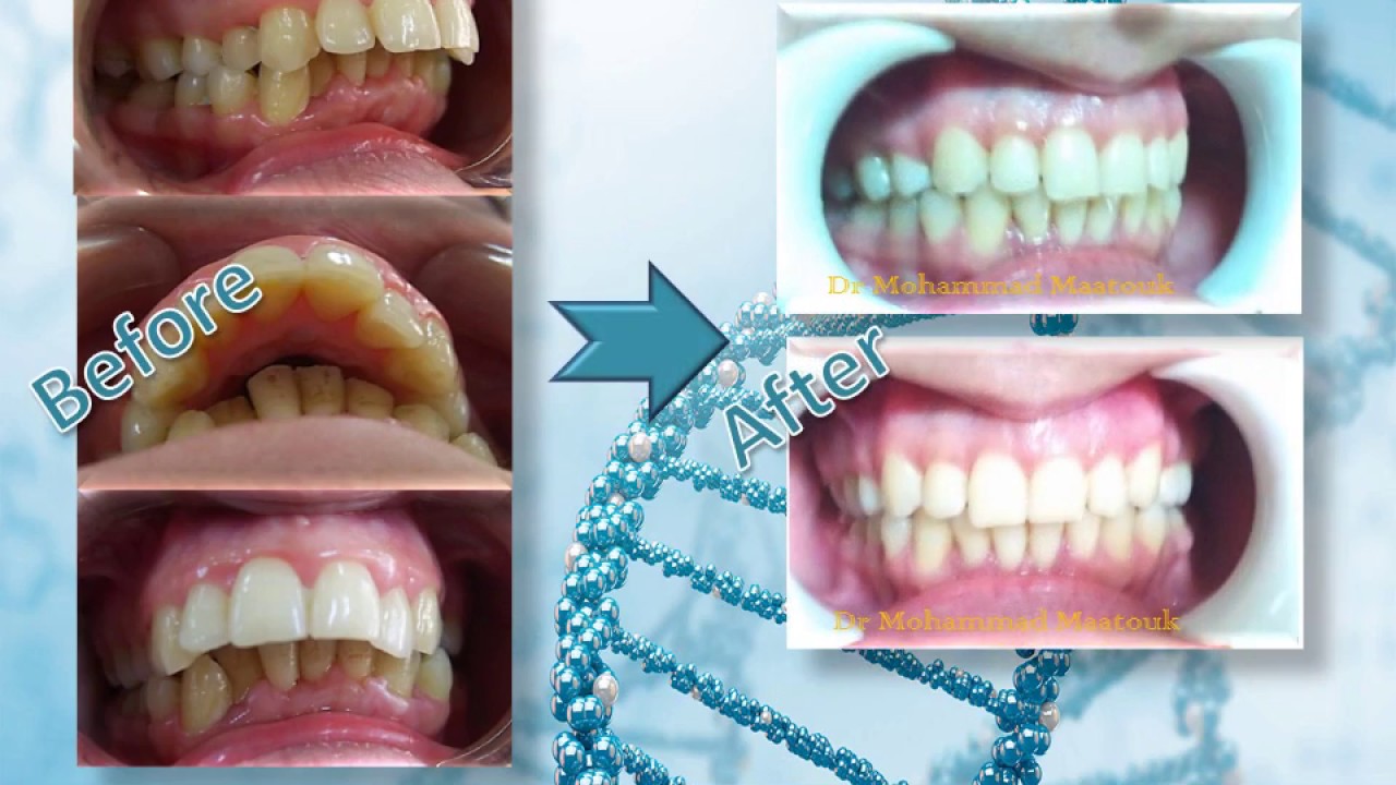 العلاج التقويمي للبروز الشديد في الأسنان العلوية     Orthodontic treatment of severe protrusion