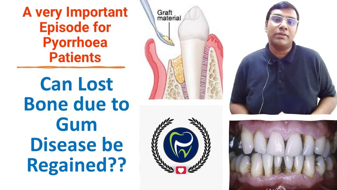 Dr Rudra Mohan | Can Bone Loss due to Gum Disease Be Reversed ? Is Periodontal Disease Reversible ?