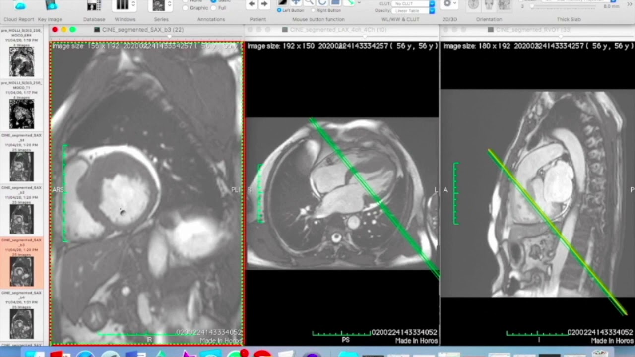 7. LV RV Volumetry Dr  Bhavana Reddy