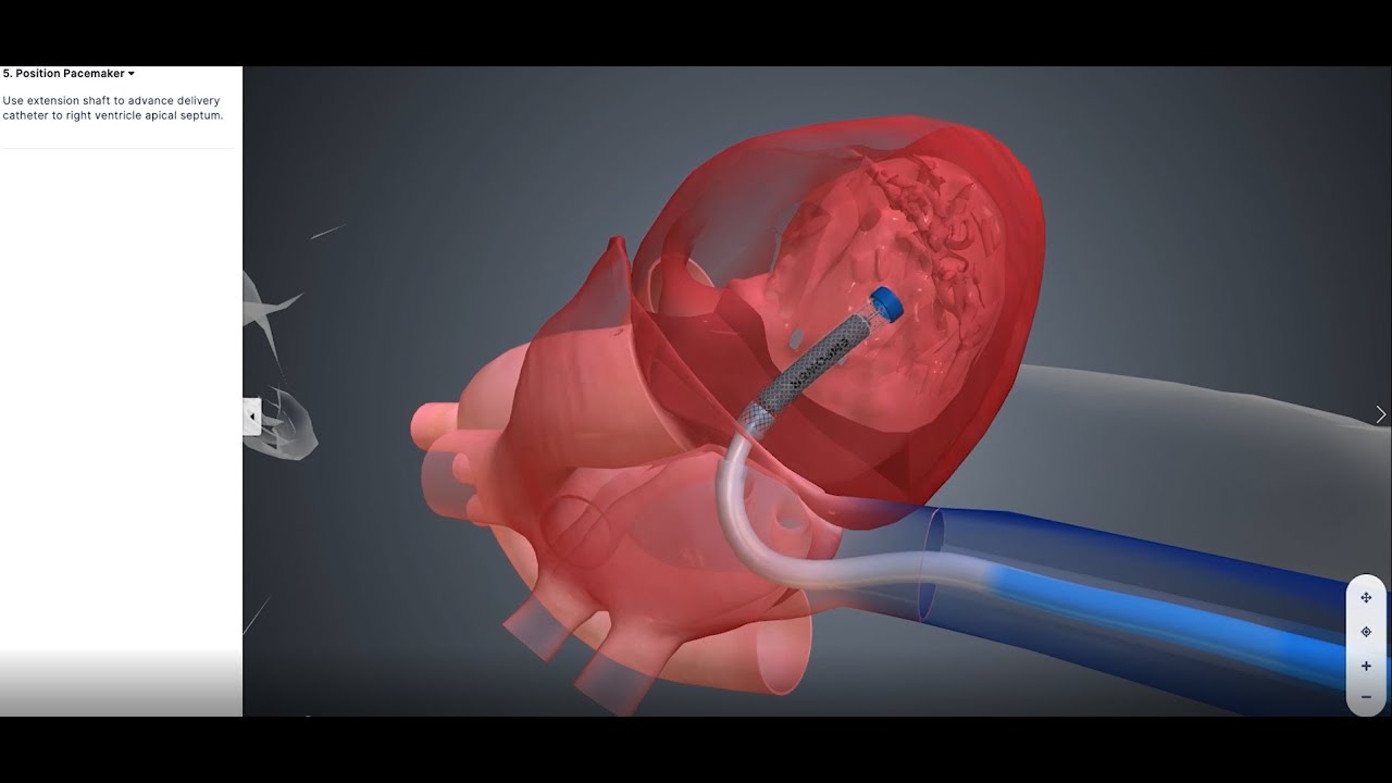 mCRM™ System: EMPOWER™ Leadless Pacemaker Implantation Animation