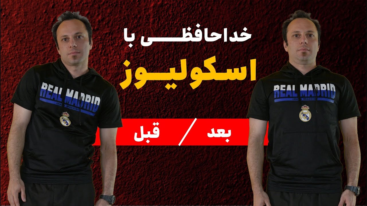 اسکولیوز - تمرینات تخصصی رهایی از انحراف ستون فقرات (صددرصد موثر)