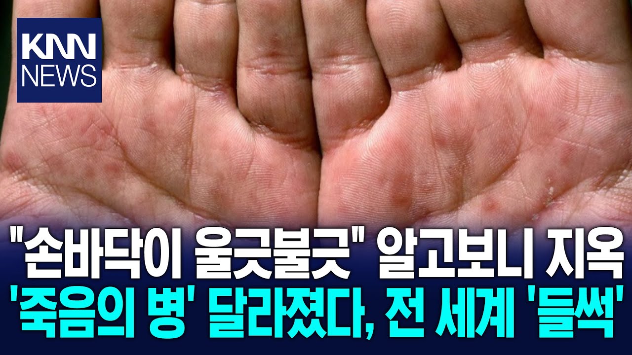 '죽음의 병' 극복 가능하나&hellip;해외도 포기한 '백신' 국내서? / KNN
