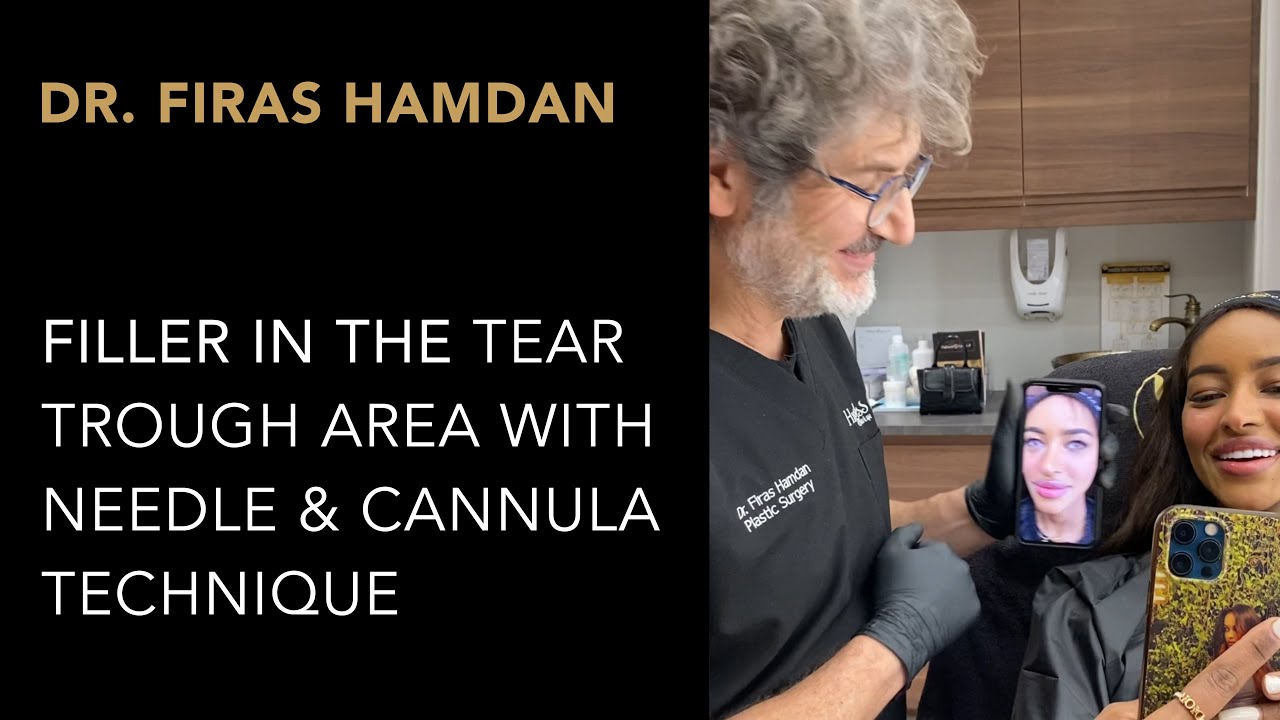 Filler In The Tear Trough Area With Needle & Cannula Technique