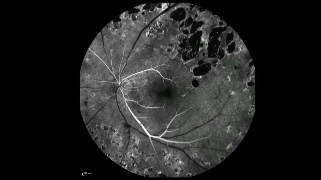 Fluorescein Angiography of the Left Eye at Baseline and at 3-Year Follow-Up