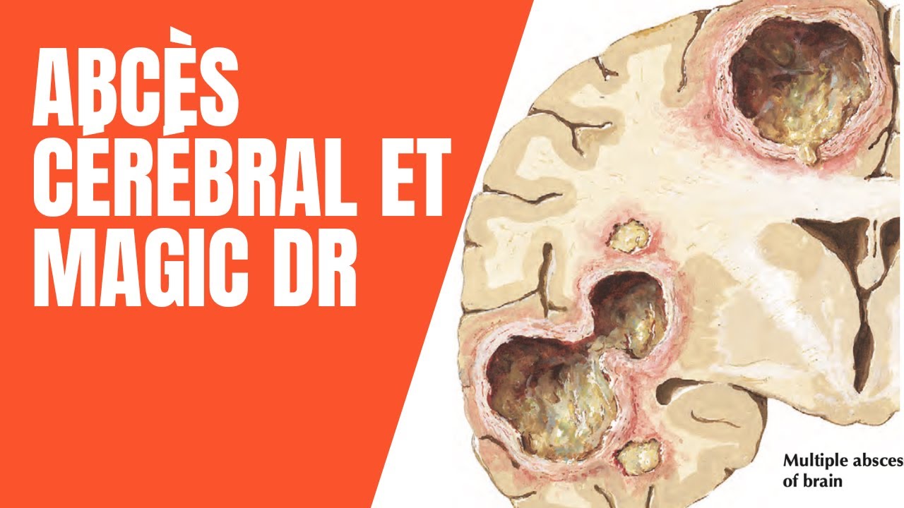 Abcès cérébral à pyogènes et MAGIC DR - Cours médecine radiologie imagerie