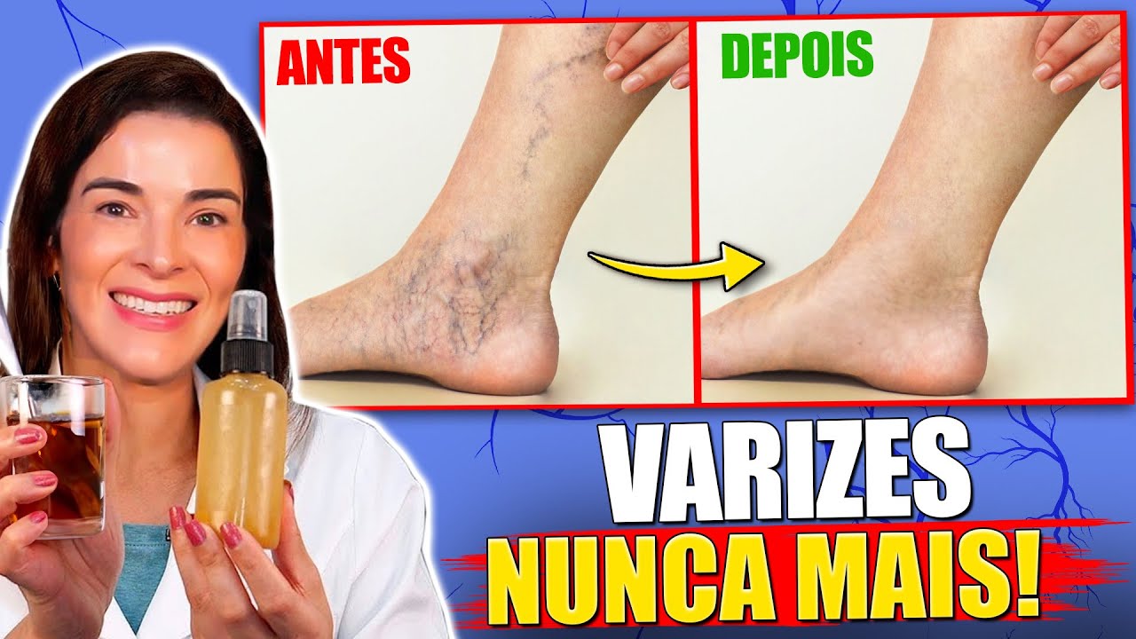Adeus Vasinhos e Varizes: Como Ativar a Circulação das Pernas em Casa