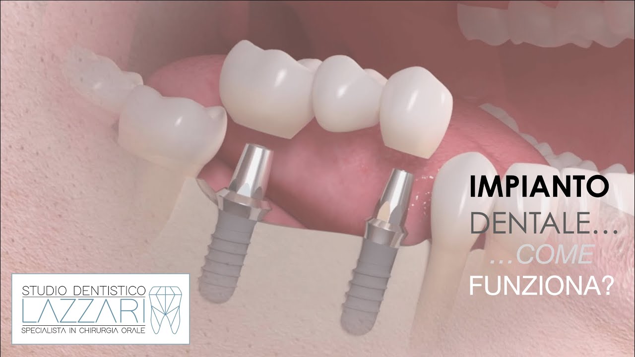 Impianto dentale. Come funziona?