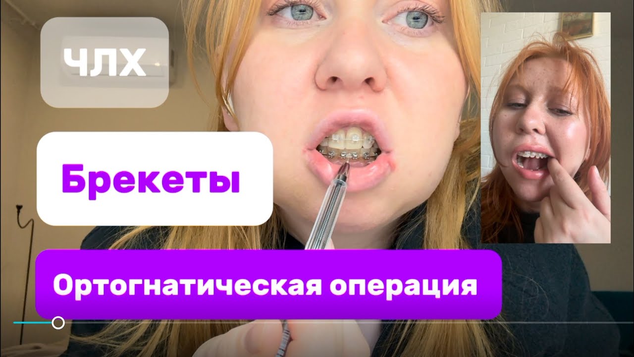 Подготовка к ортогнатической операции,неудачное брекет лечение,дистальный прикус,2 скелетный класс  
