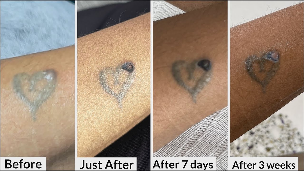 Plasma laser removal of keloid looking lump granuloma from tattoo scar