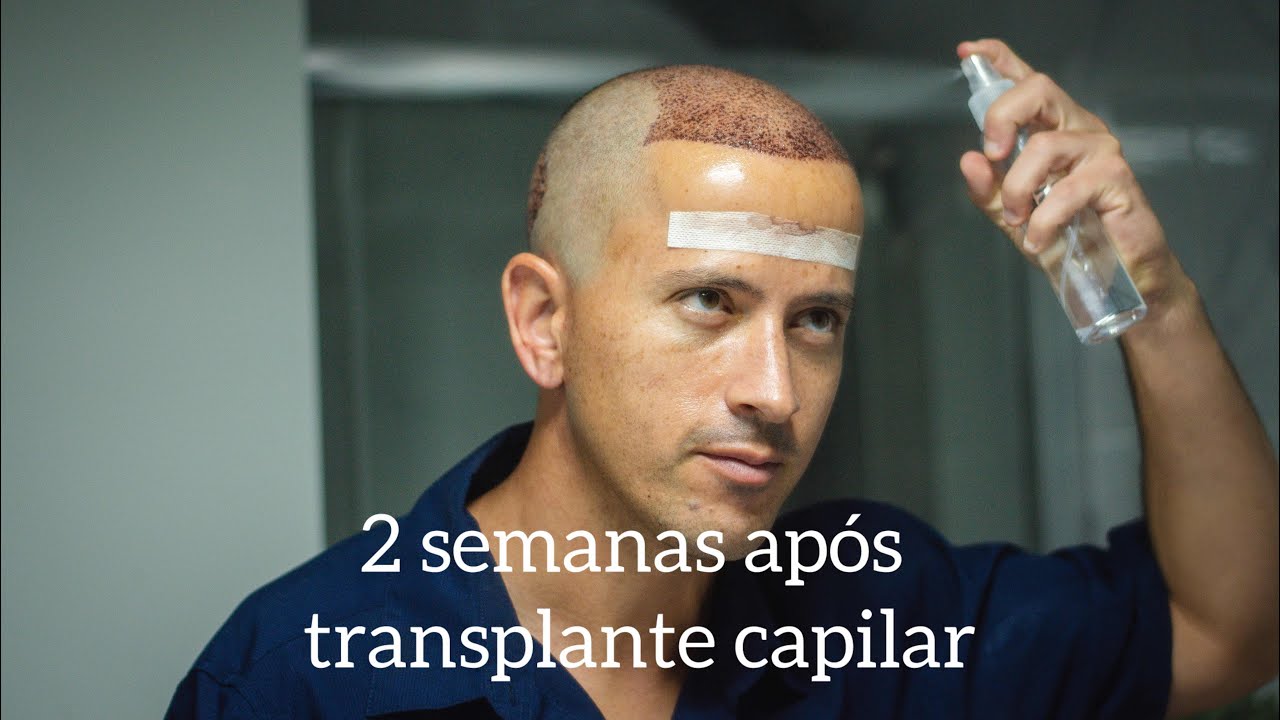 2 semana após transplante capilar