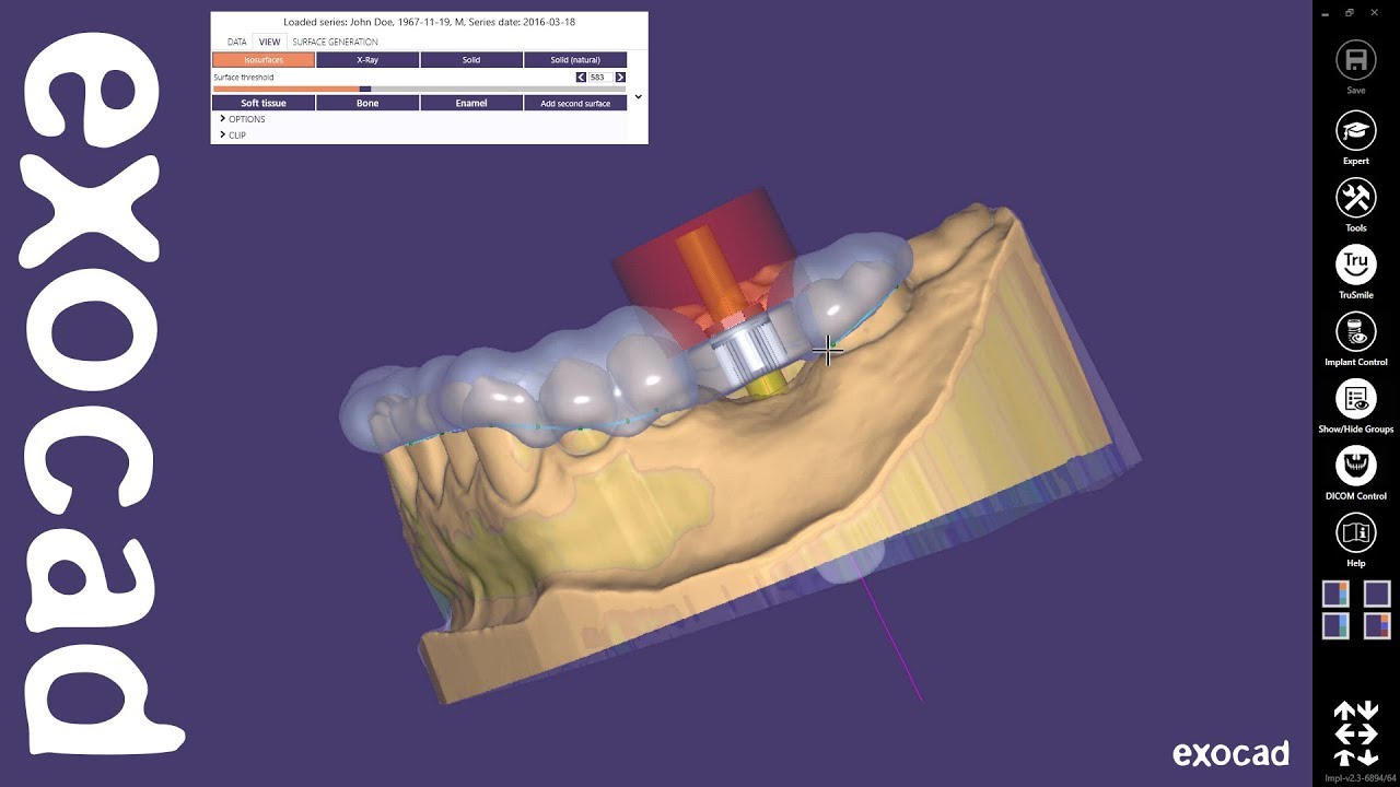 exocad Quick Guide: Get most out of guided surgery