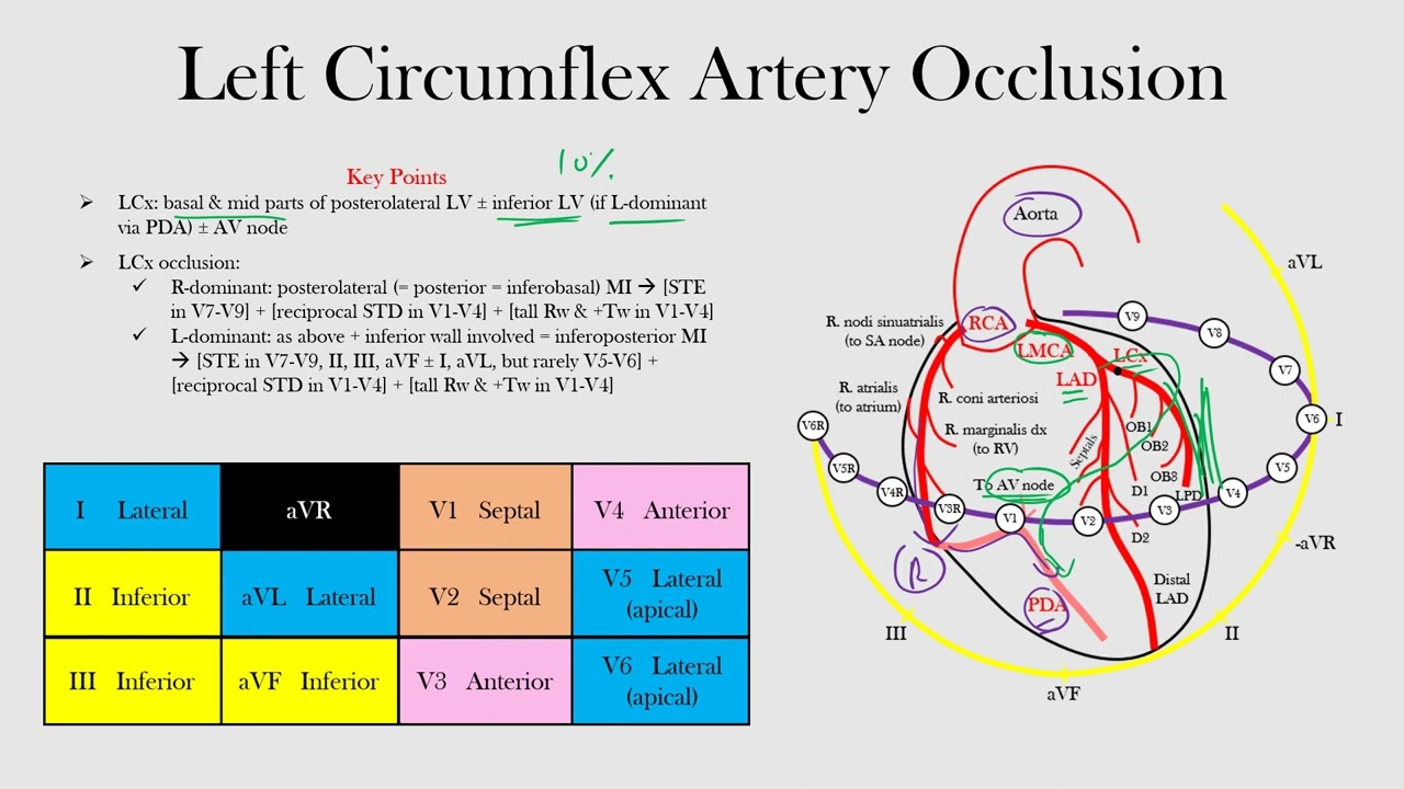 Left Circumflex Artery Occlusion