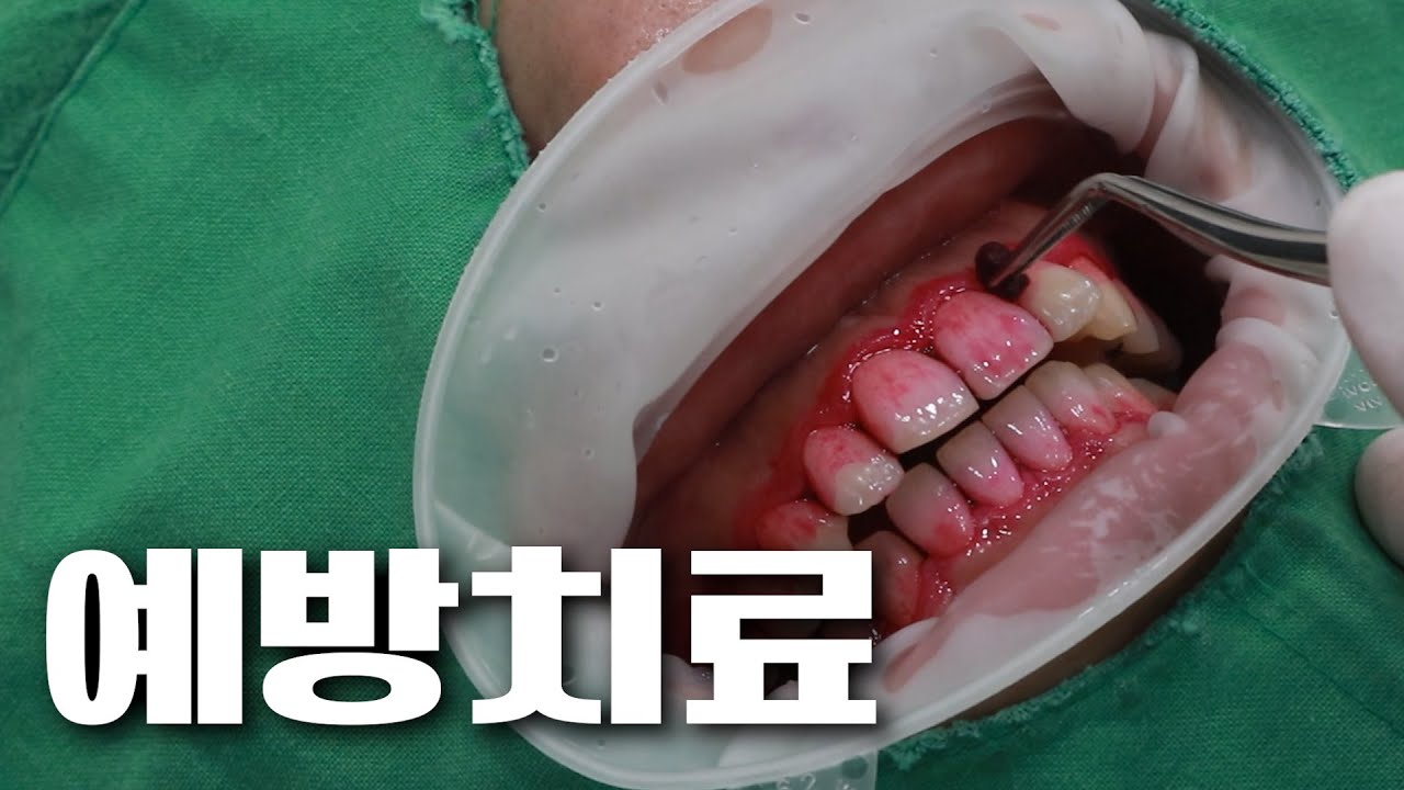 (울산치과) 이 시대의 예방치료 방법