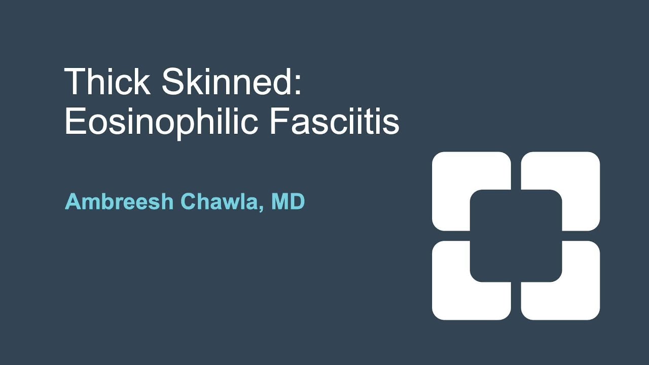 Diagnosis and Treatment of Eosinophilic Fasciitis