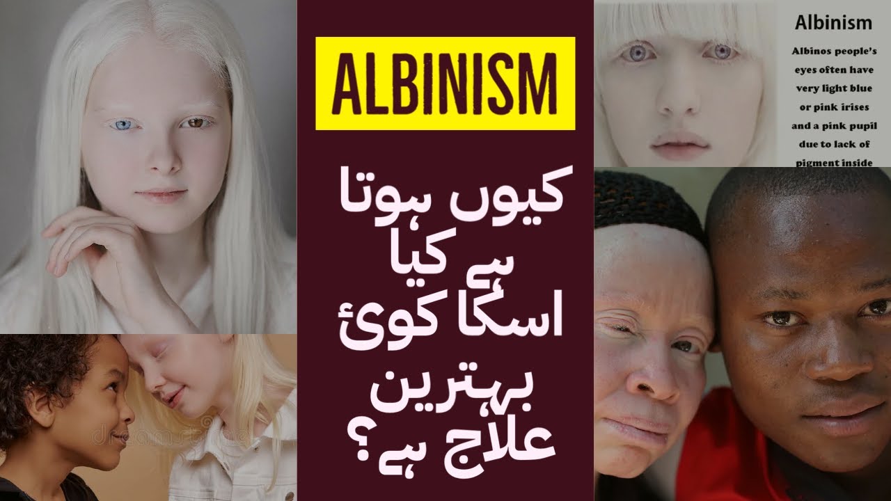 Albinism in Urdu