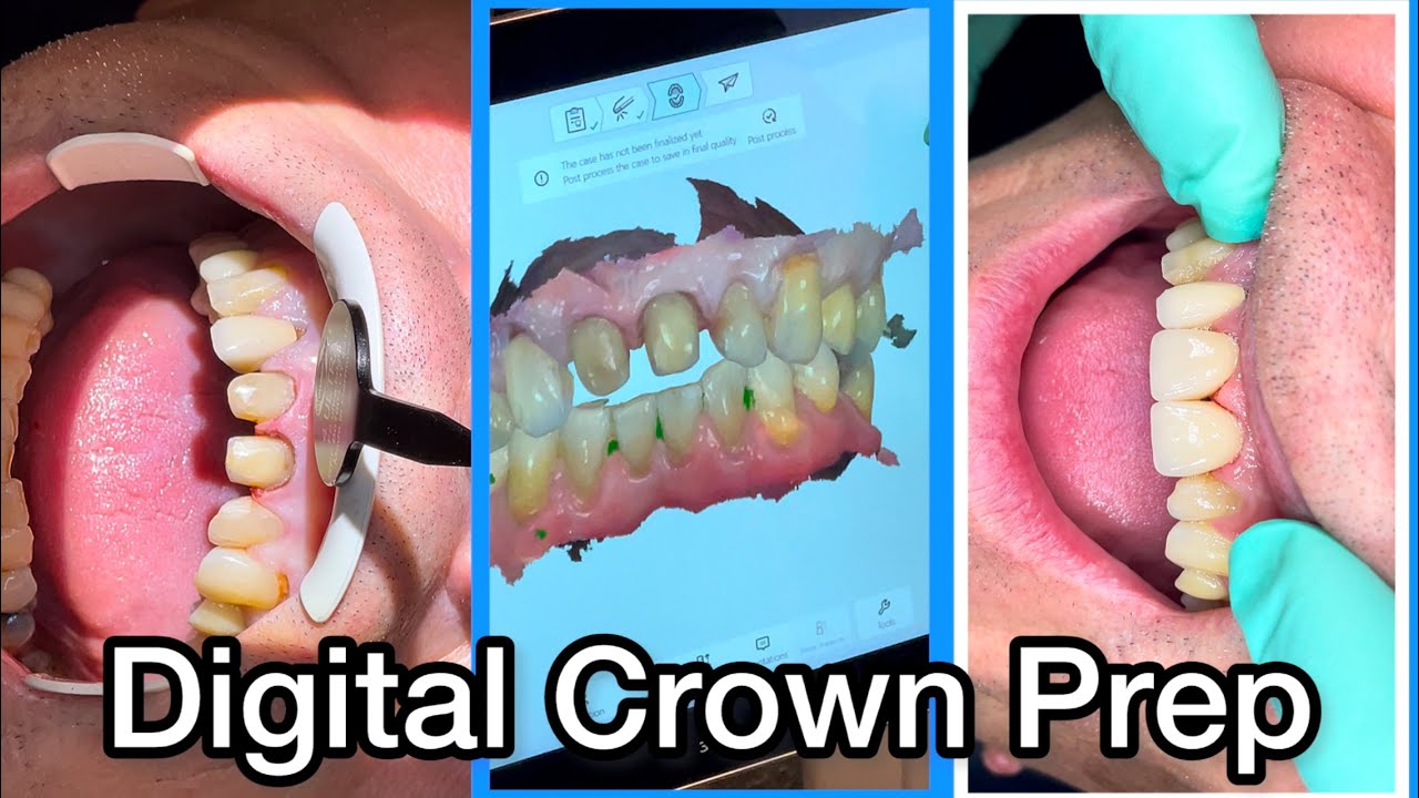 Anterior Zirconia Crown Preparation & Digital Intraoral Scan | High-Precision Workflow