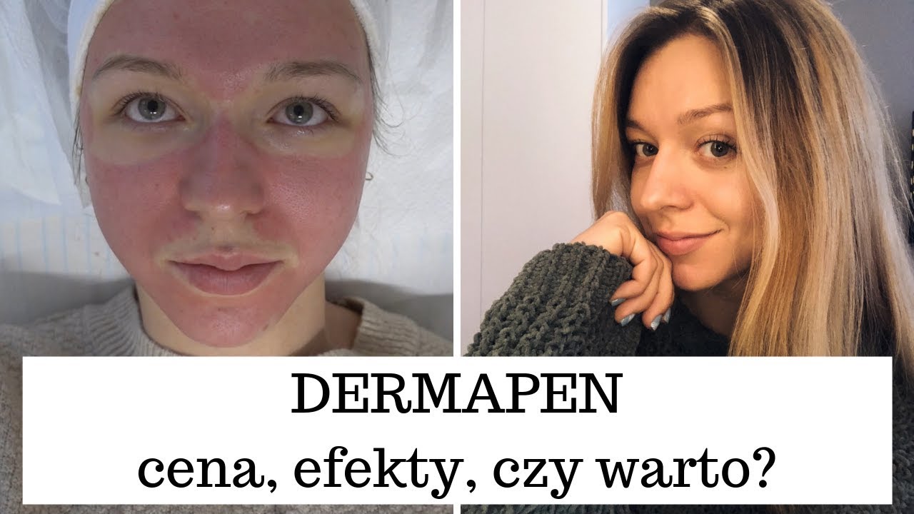 DERMAPEN | MEZOTERAPIA  MIKROIGŁOWA | GENEO