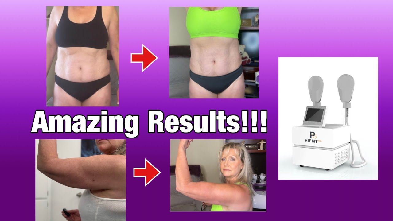 Результаты HIEMT!! | УДИВИТЕЛЬНЫЕ результаты от HIEMT | EMSCULPT ДОМА!!