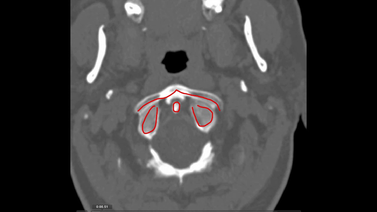 Anatomía CT Cervical