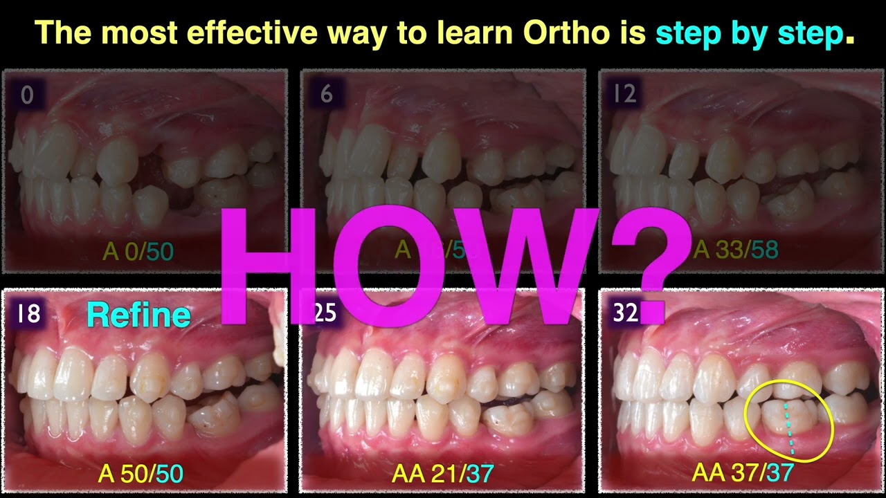 Congenital Missing 35｜【Chris Chang Ortho】CC871